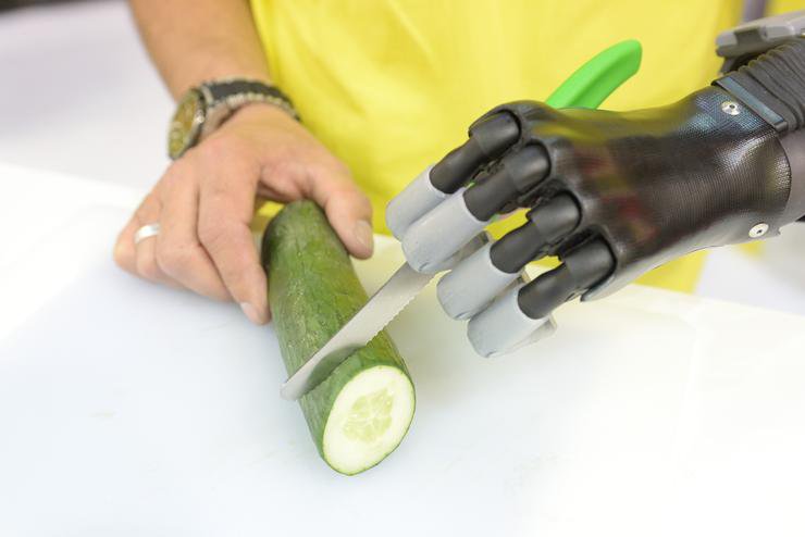 Quadruple Amputee Patient Receives New Bionic Hands